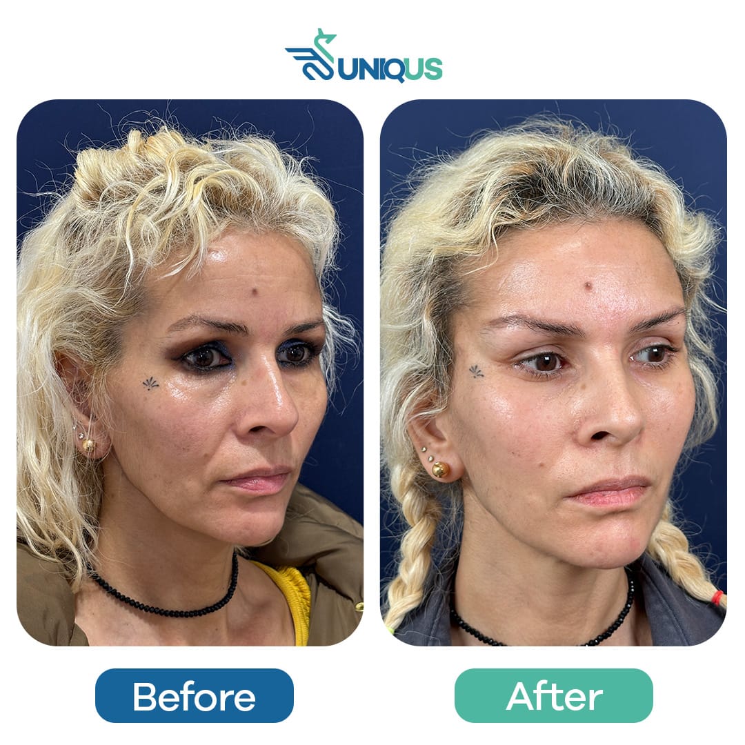 Before & After