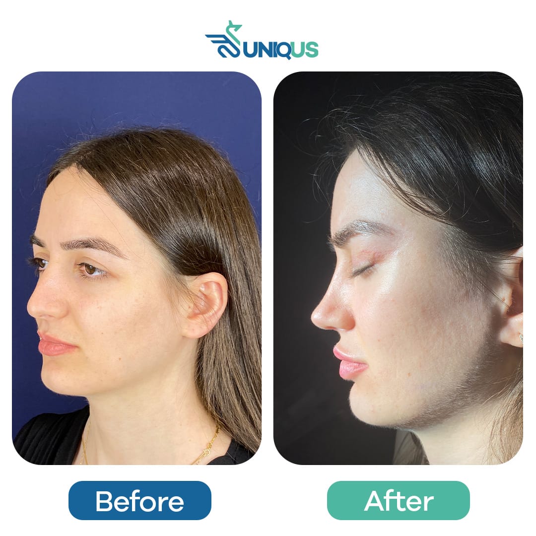 Before & After