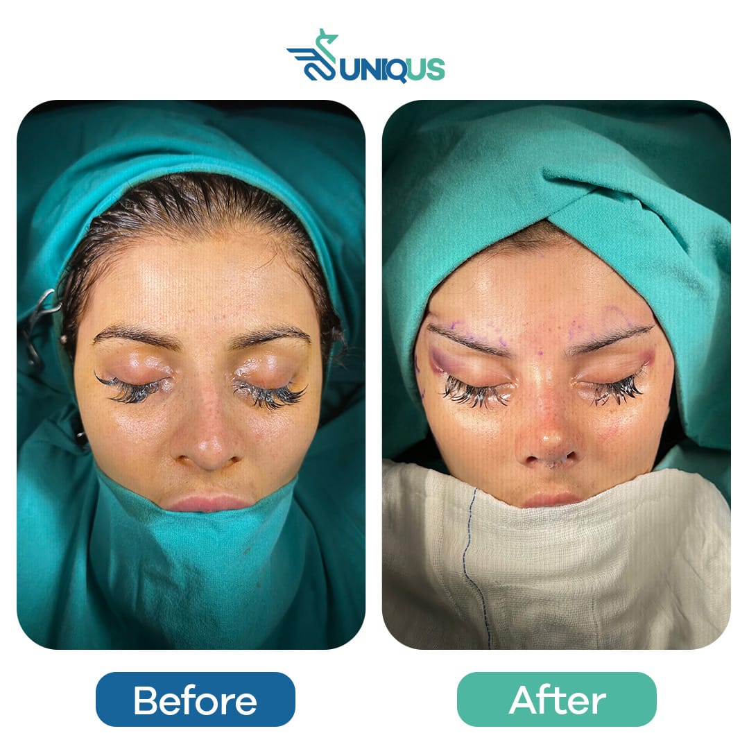 Before & After