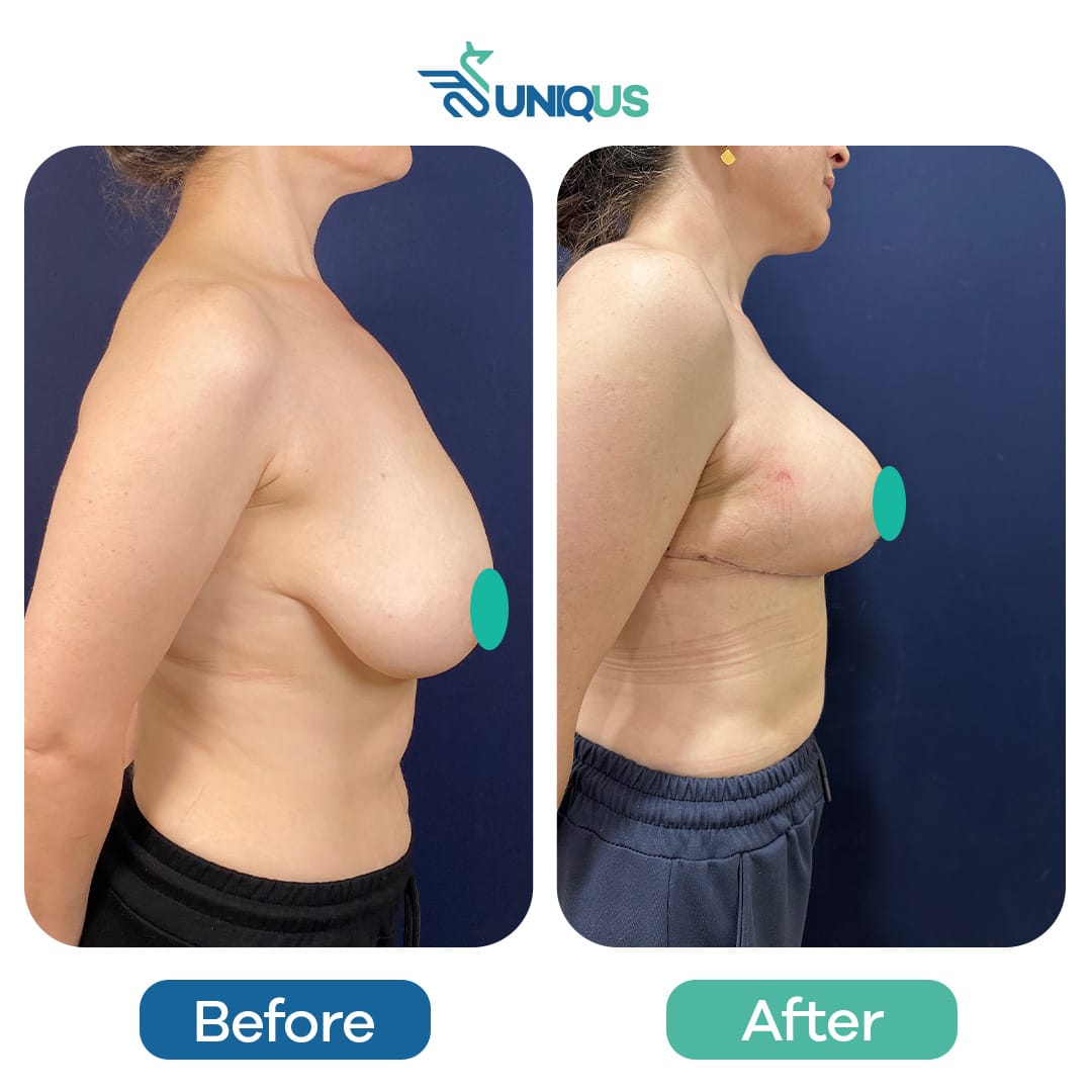 Before & After